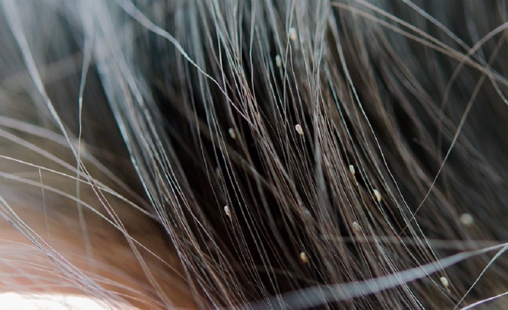 What to do If My Newborn Baby Has Lice Natural Lice Treatment For